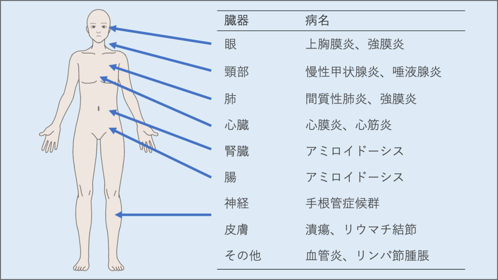 関節リウマチの症状