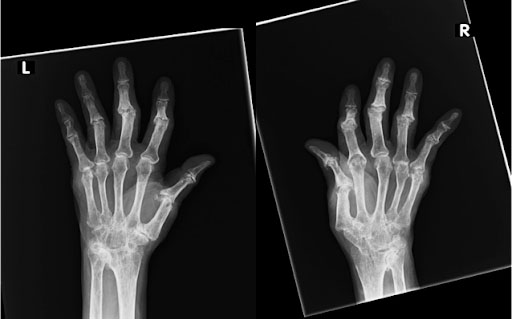 関節の変形が進んだ手のレントゲン写真（70歳代女性）